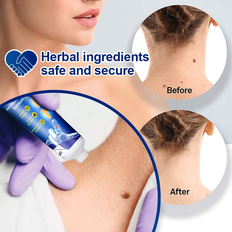Wart Remover Treatment Cream